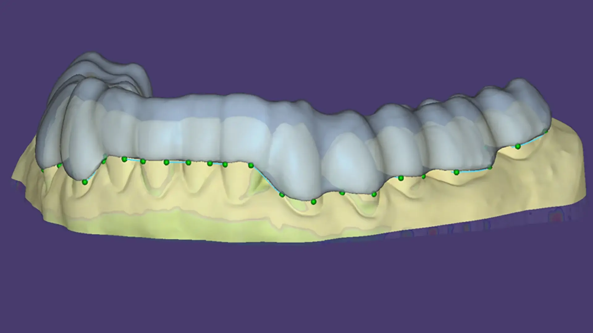 EXOCAD DentalCAD Core - Szyny nagryzowe