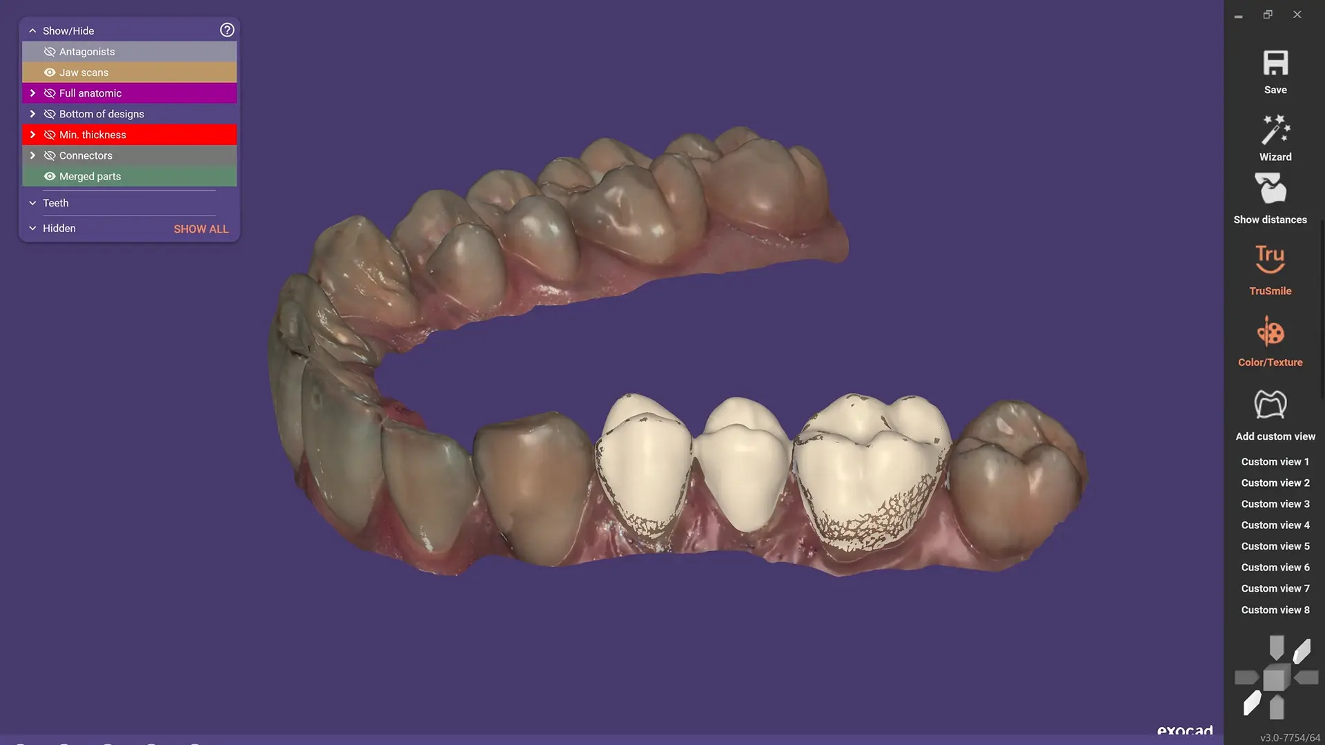 EXOCAD DentalCAD Core - Prowizorium