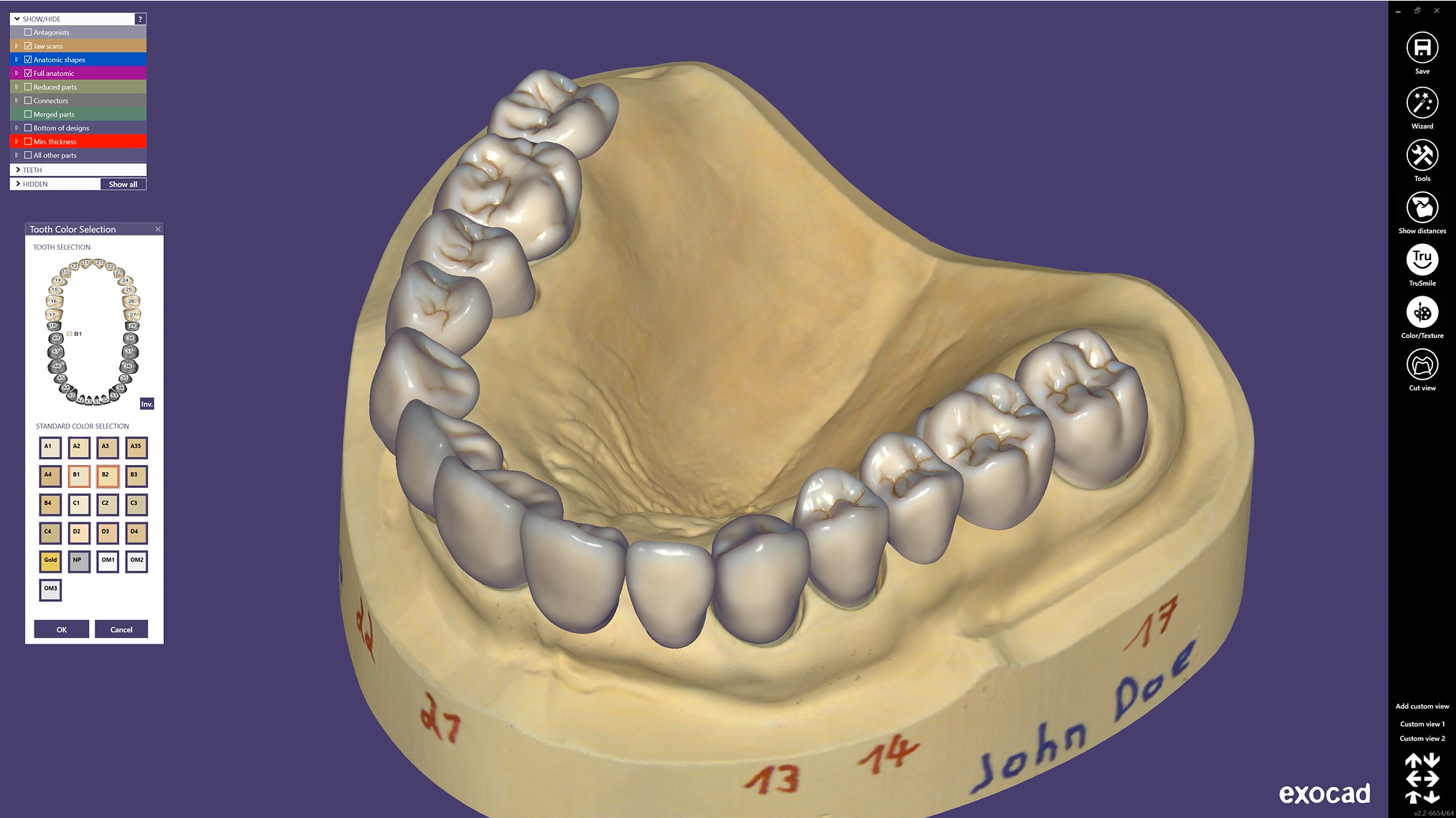 EXOCAD DentalCAD Core - TruSmile