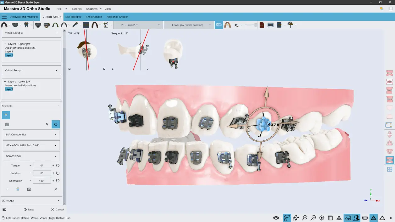 Maestro3D Ortho-Studio | Indirect Bonding